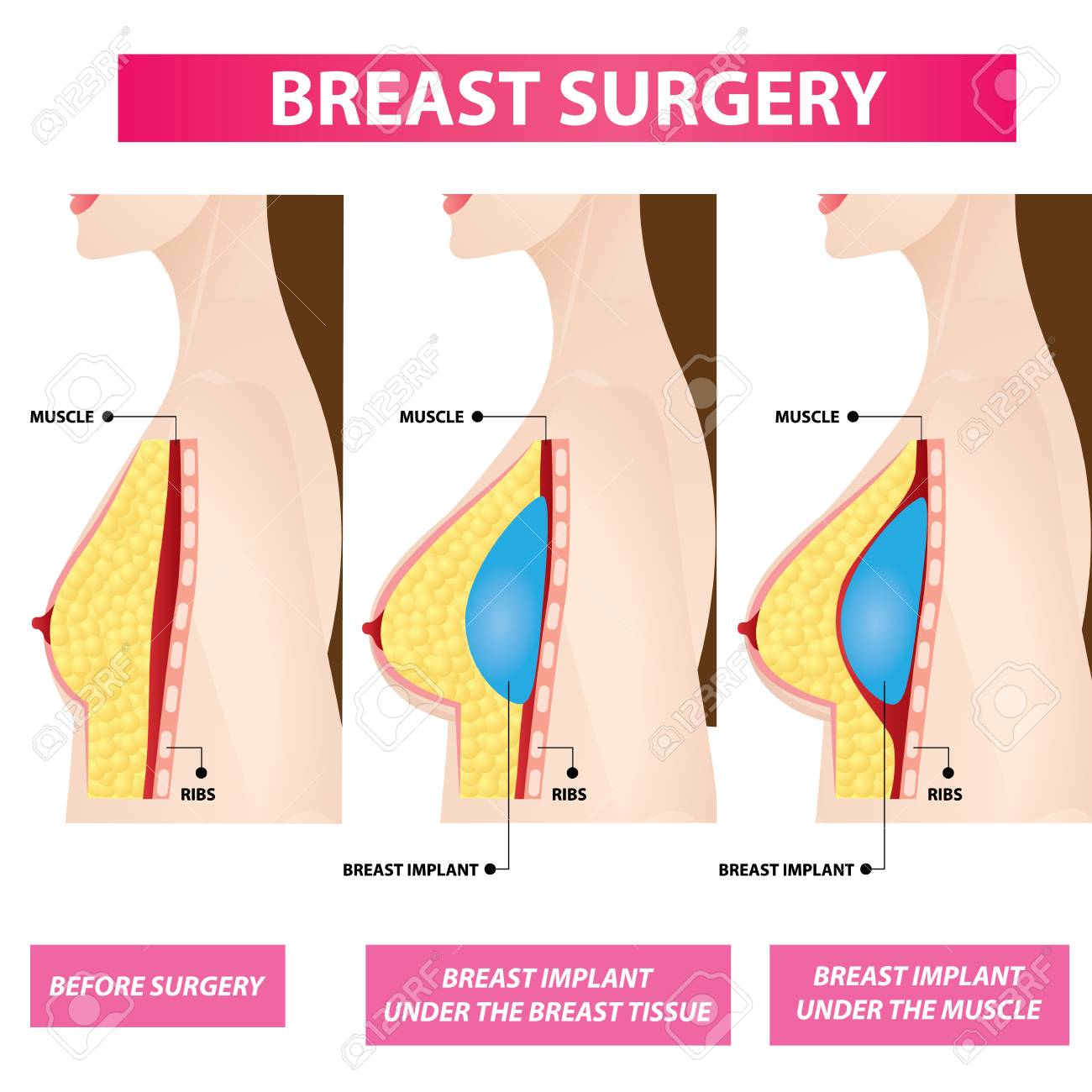 Breast Augmentation Size Chart