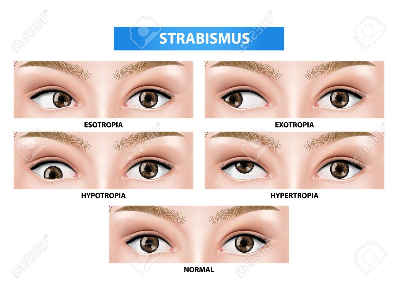 Strabismus Crossed Eye Vector Illustration Royalty Free Cliparts Vectors And Stock Illustration Image