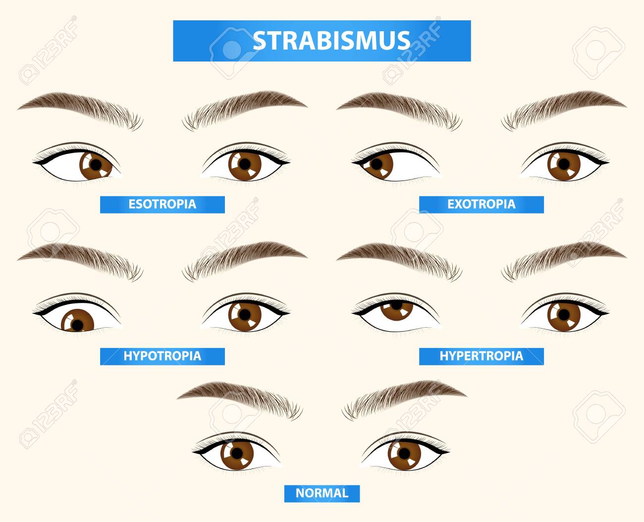 Strabismus Crossed Eye Vector Illustration Royalty Free Cliparts Vectors And Stock Illustration Image