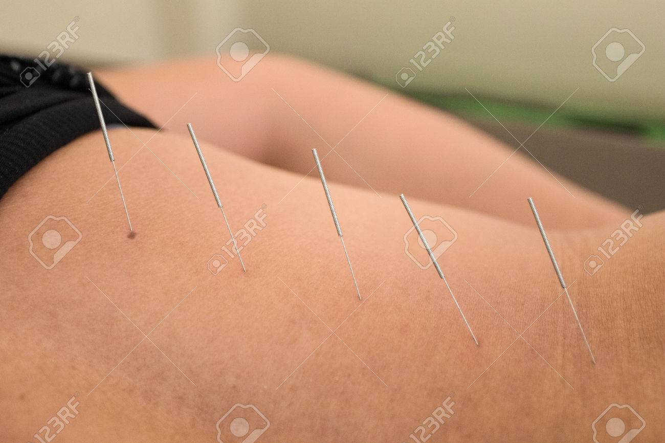 中國の鍼 希少・入手困難】 中國の鍼 今井絹子著 鍼灸 中医学 針灸