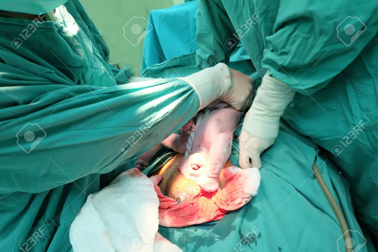 操作室出産赤ちゃん間違った位置を下から帝王切開妊娠母 の写真素材 画像素材 Image