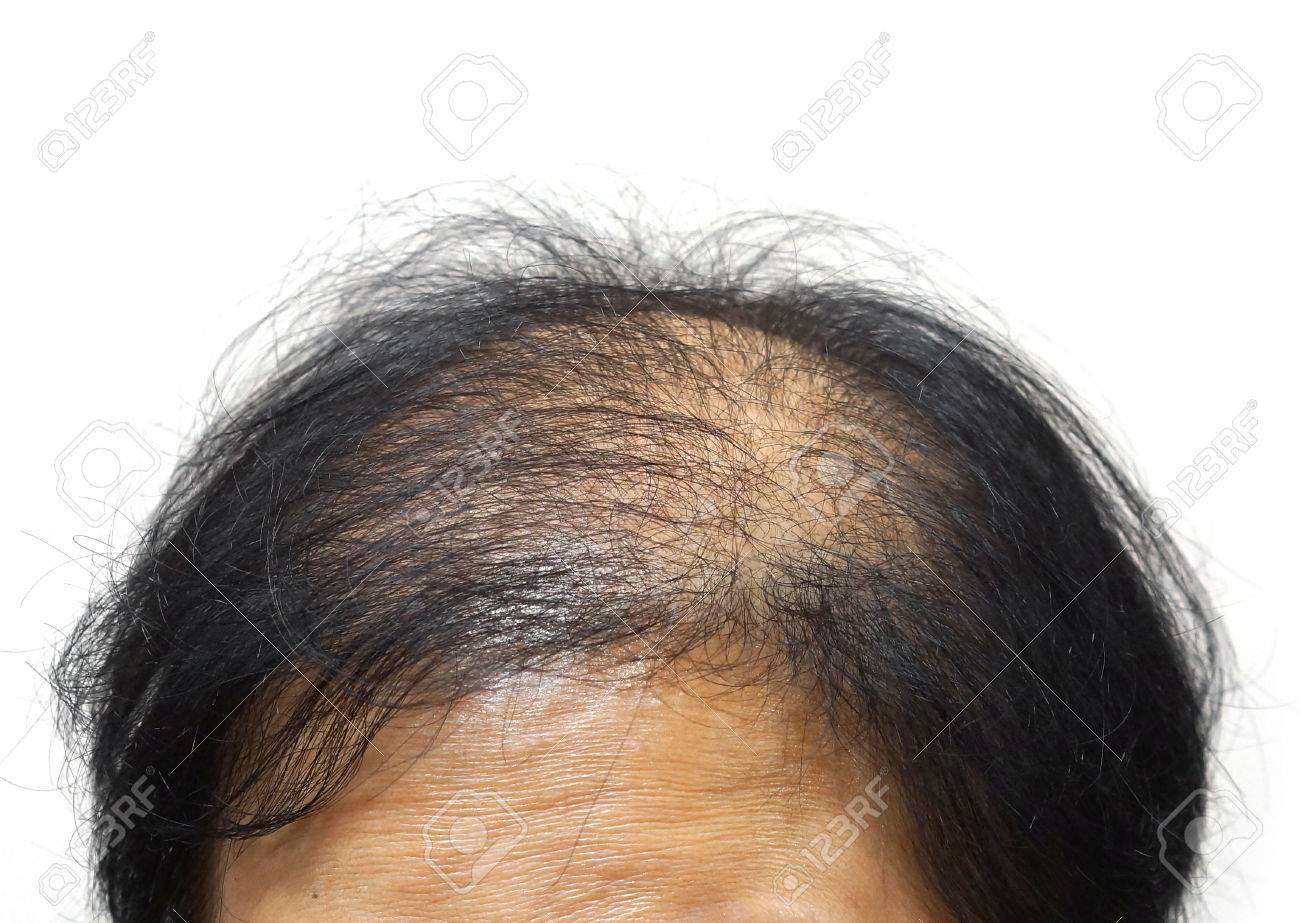 61983902-asian-female-head-with-hair-loss.jpg