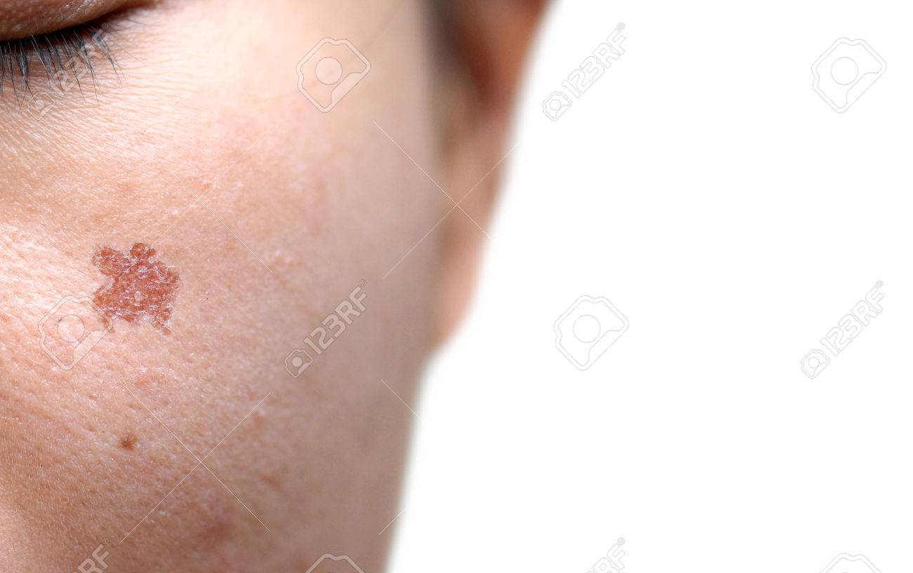 レーザー治療から その結果女性の顔の傷の傷跡 美容皮膚治療コンセプト の写真素材 画像素材 Image 65