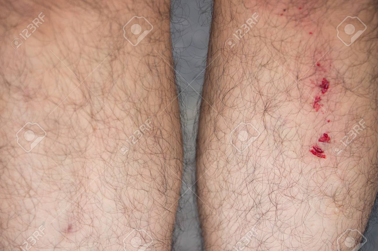 Piernas de telangiectasia arborización
