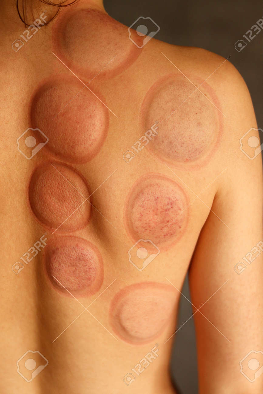 Cupping Therapy Ventosas En Espalda Moretones Rastros En La