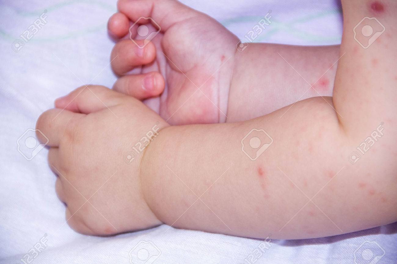 una pequeña mano de niño cubierto por eczema alergia bebé piel