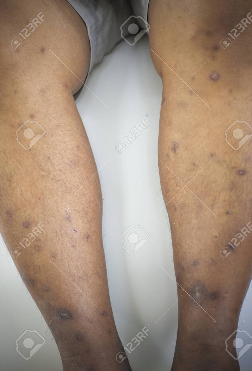 Skin And Scar Disease Dark Spots On The Legs Stock Photo Picture And Royalty Free Image Image 149492141