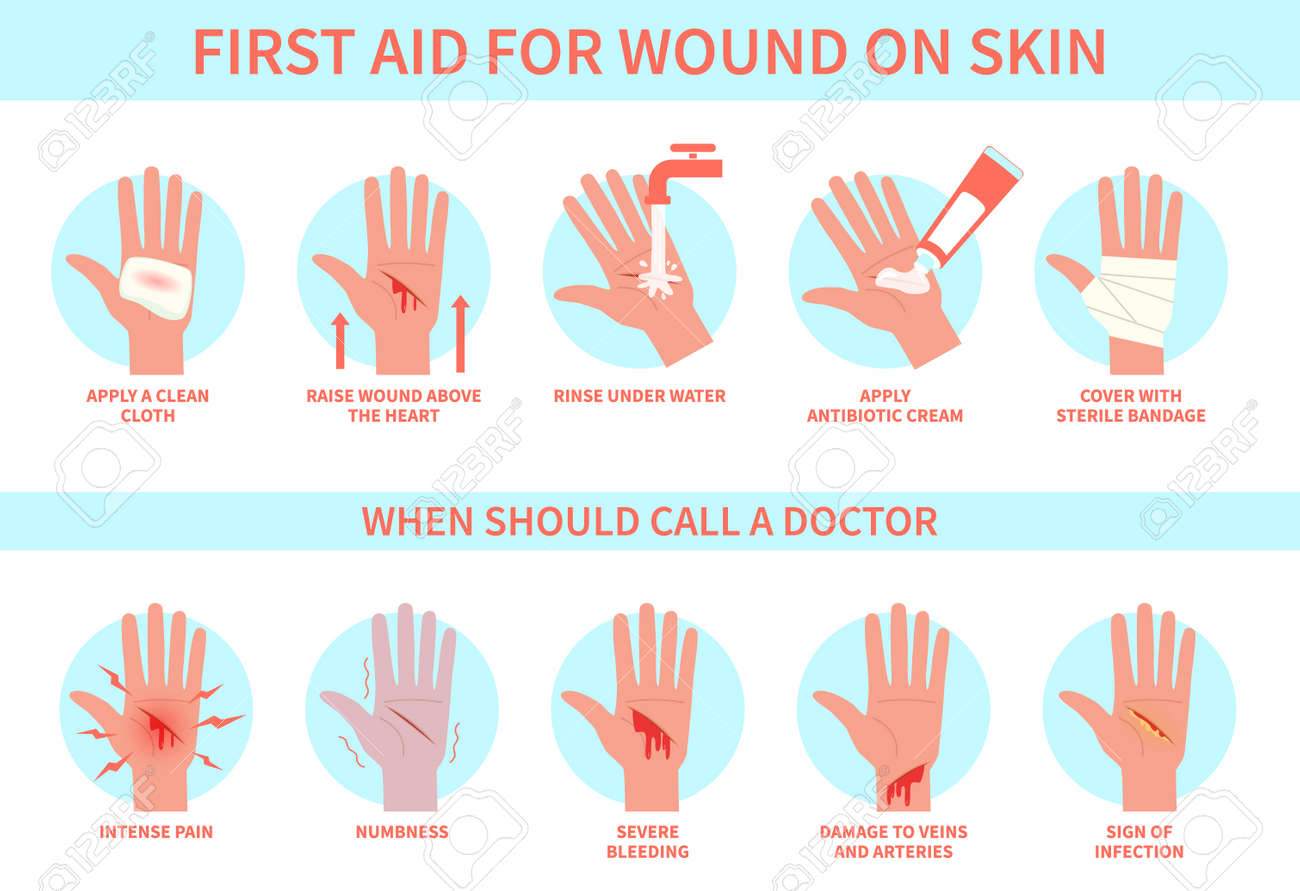First aid for wound on skin. Damage, hurt bleeding cut hand skin and emergency treatment procedure, therapy injury medical guide, information poster help steps for clinics vector flat infographic - 158258032 First aid for wound on skin. Damage, hurt bleeding cut hand skin and emergency treatment procedure, therapy injury medical guide, information poster help steps for clinics vector flat infographic - 158258032
