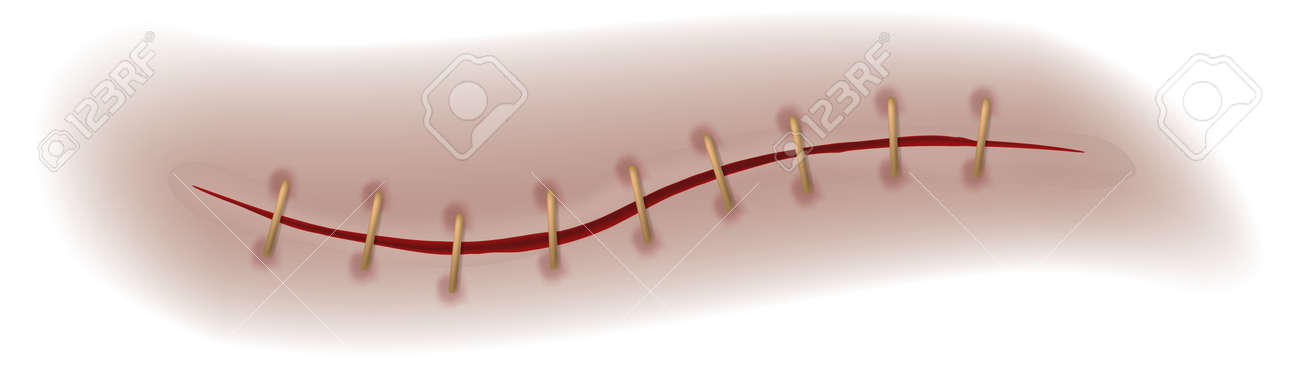 Scar or wound. Realistic bloody stitch. Surgical sutures healing seam closeup texture, human body medical curing steps operation, injury and disability vector isolated illustration - 171265368 Scar or wound. Realistic bloody stitch. Surgical sutures healing seam closeup texture, human body medical curing steps operation, injury and disability vector isolated illustration - 171265368