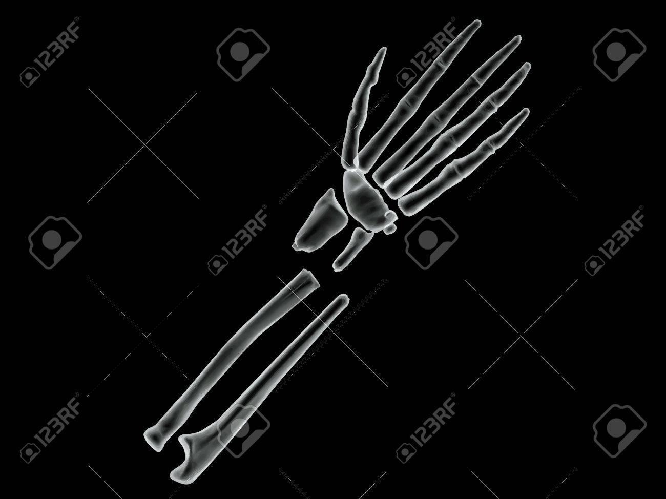 Vector Broken Bone X-ray Image 2 Royalty Free SVG, Cliparts, Vectors, And  Stock Illustration. Image 41069691.