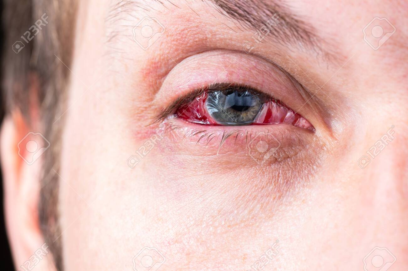 postoperative heavy inflamed eye closeup shot with selective focus - 135647795 postoperative heavy inflamed eye closeup shot with selective focus - 135647795