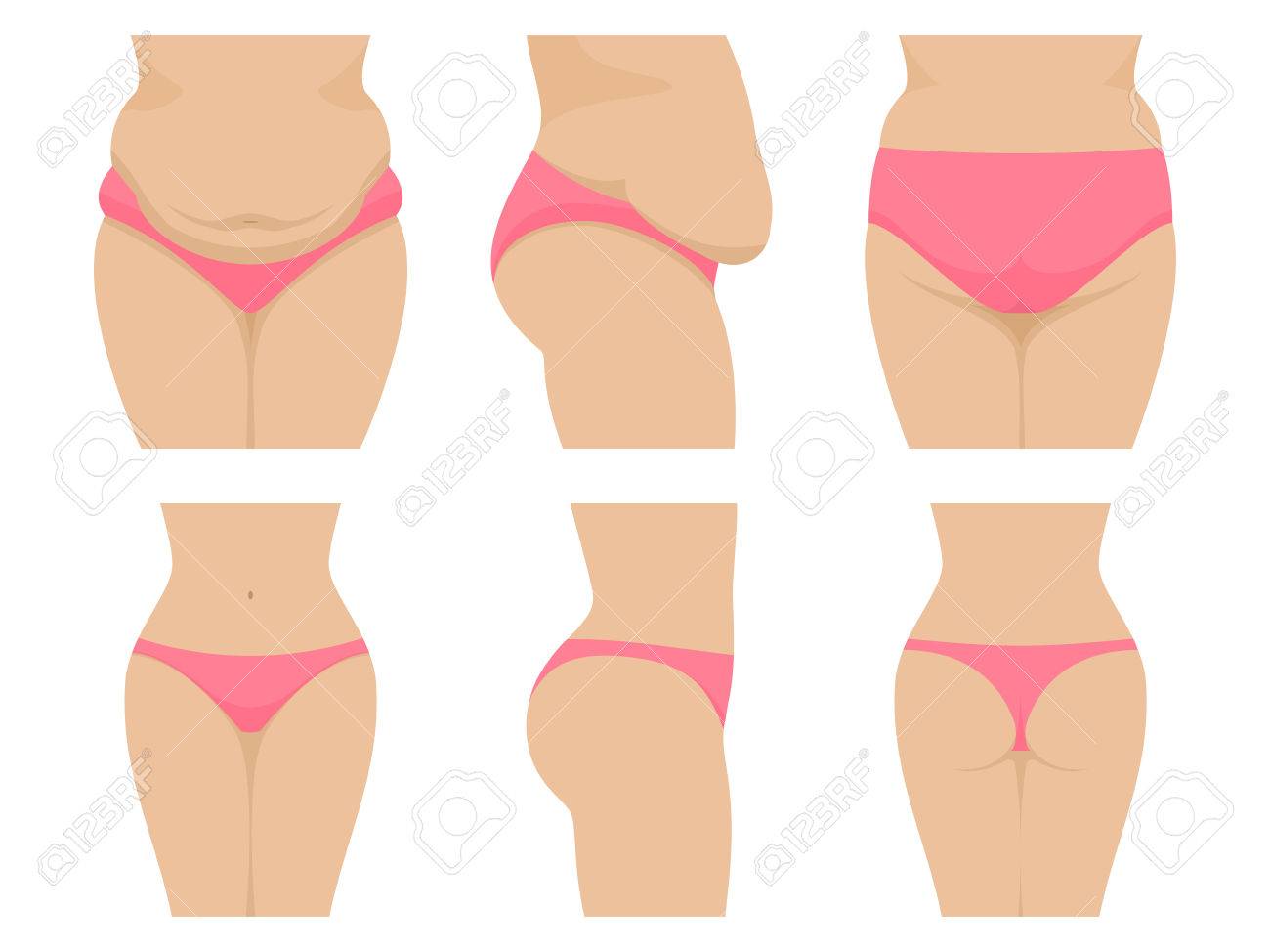Liposuction de caderas antes y despues de adelgazar