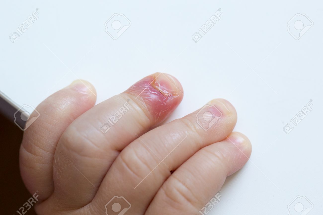 dedo hinchado de la mano infeccion