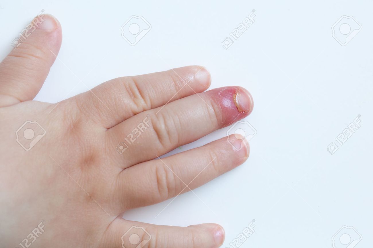 inflammation i fingret