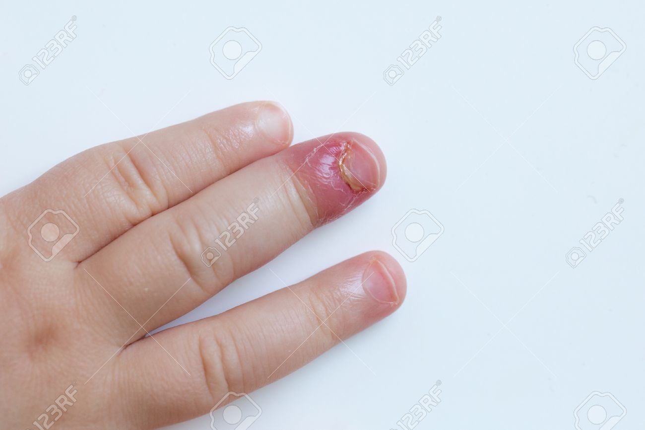 inflammation i fingerled inflammation i fingerled