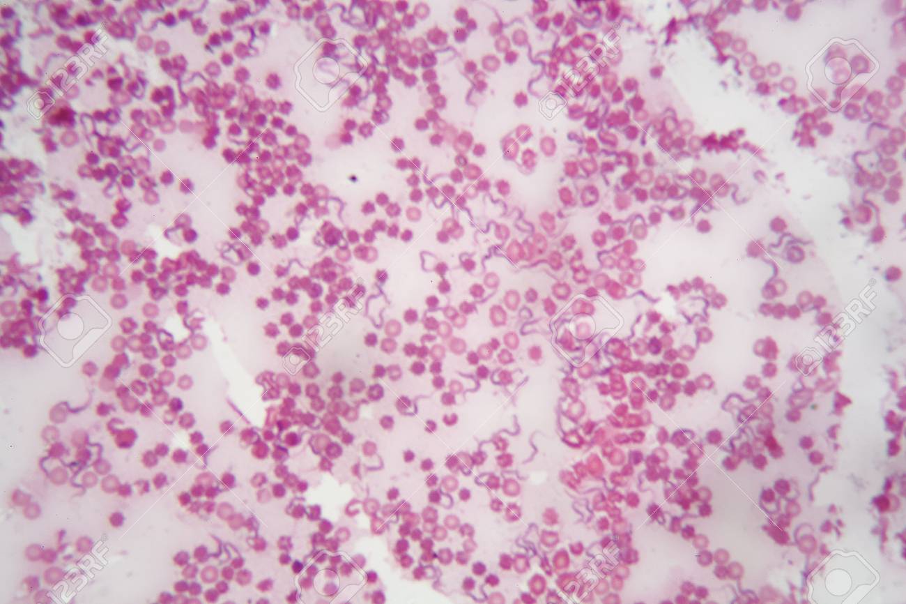 que significa tripanosomiasis africana humana