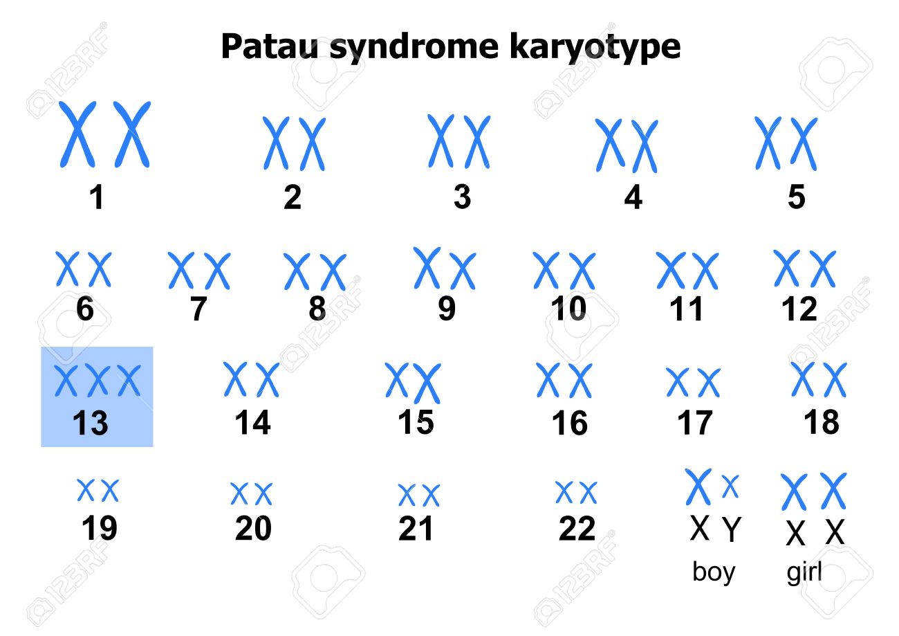 Patau syndrome